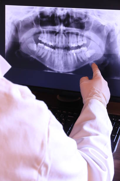 Best Emergency Wisdom Teeth Removal in Mountlake Terrace, WA